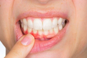 Diş əti xəstəliyini 4 qat artıran səbəb: infeksiya yaradır
